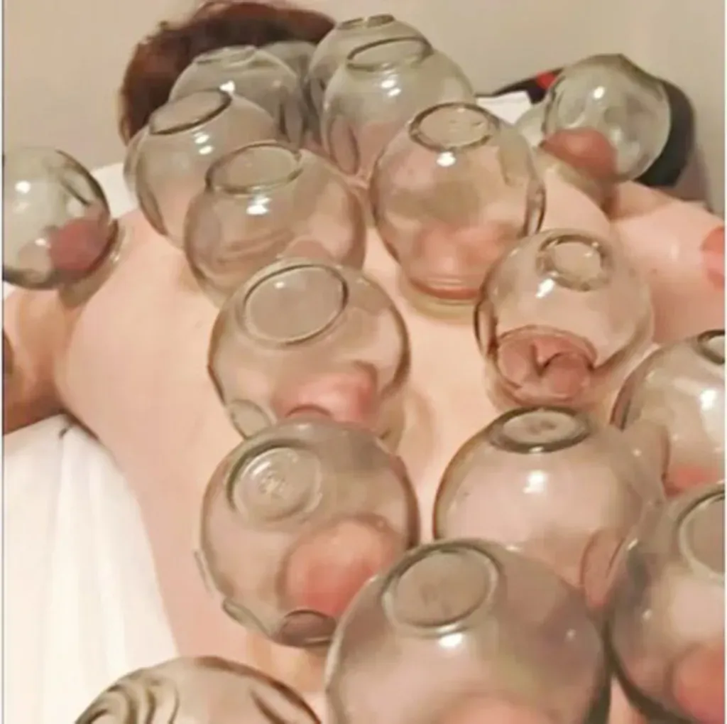 玉足養生館 — 拔罐調理，多個玻璃罐沿背部排列